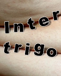 Der brust unter intertrigo Intertrigo: nässendes